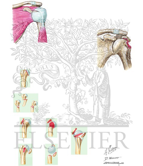 Neer Classification
