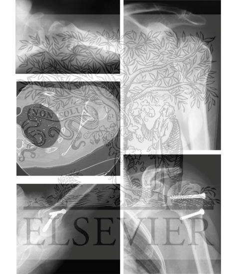 Watermarked preview of unlabeled image: Two Part Surgical Neck Fracture And Humeral Head Dislocation