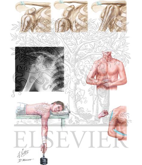 Anterior Dislocation Types and Stimson Maneuver