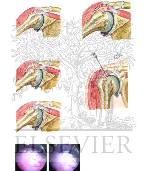 Watermarked preview of unlabeled image: Calcific Tendonitis