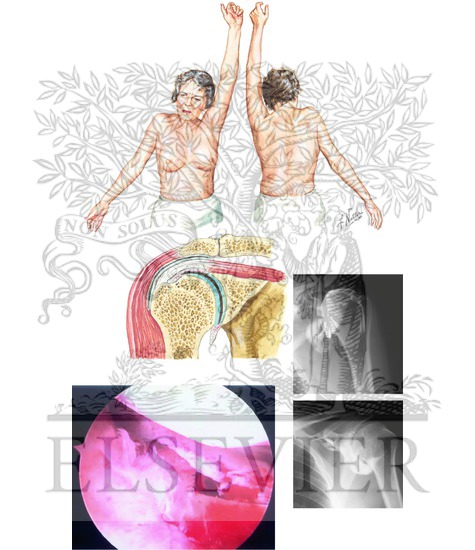 Watermarked preview of unlabeled image: Clinical Presentation of Frozen Shoulder