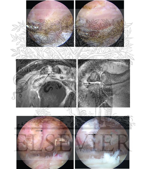 Watermarked preview of unlabeled image: Impingement Syndrome and the Rotator Cuff:  Radiological and Arthroscopic Imaging