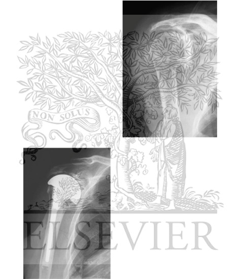 Watermarked preview of unlabeled image: Rotator Cuf-Deficient Arthritis (Rotator Cuff Tear Arthropathy): Radiographic Findings