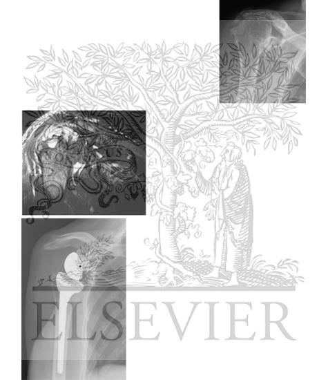 Watermarked preview of unlabeled image: Rotator Cuff-Deficient Arthritis (Rotator Cuff Tear Arthropathy): Radiographic Findings (Continued)