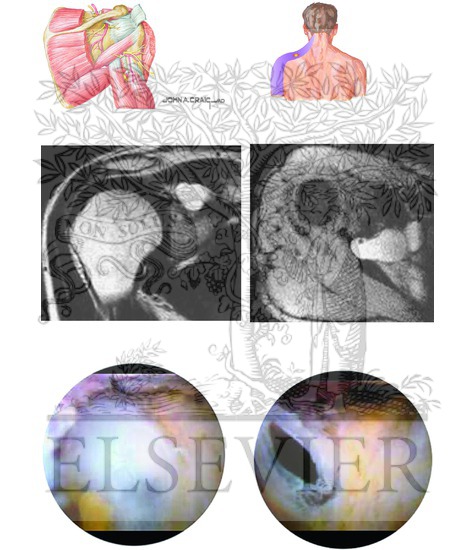 Watermarked preview of unlabeled image: Suprascapular Nerve