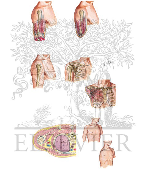 Amputation of Upper Arm and Shoulder