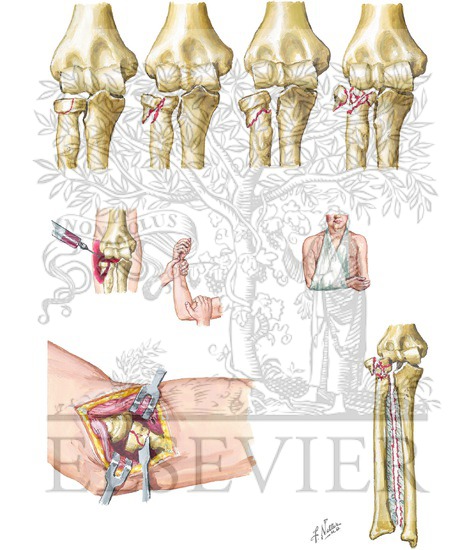Radial Head and Neck Fractures