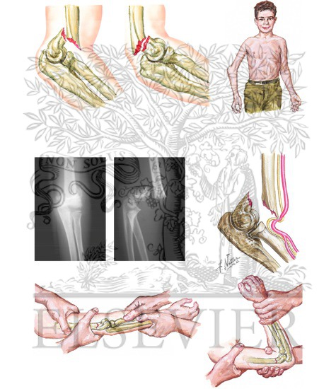 Supracondylar Humerus Fractures