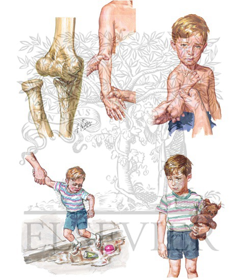 Watermarked preview of unlabeled image: Subluxation of Radial Head