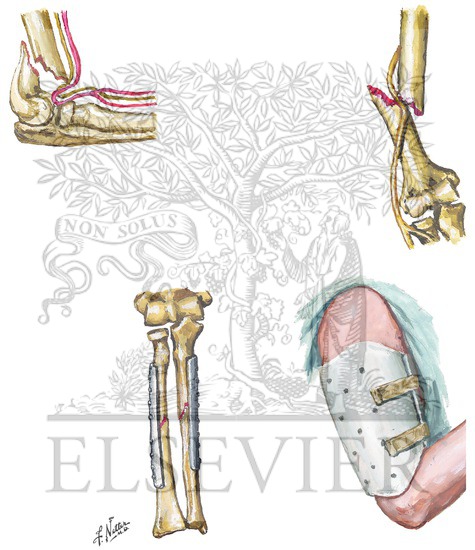 Watermarked preview of unlabeled image: Complications of Fracture