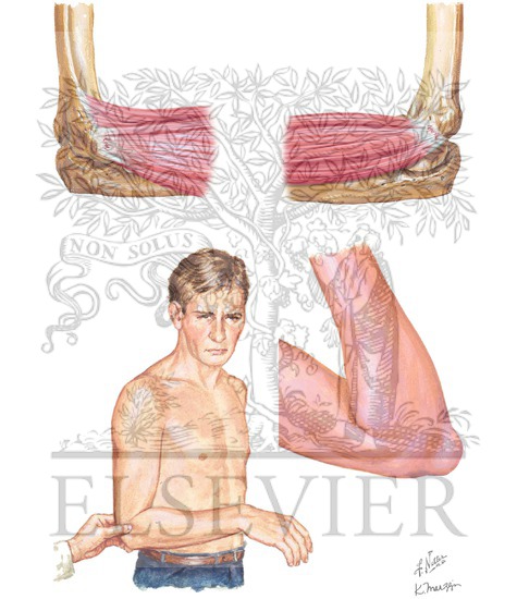 Watermarked preview of unlabeled image: Epicondylitis and Olecranon Bursitis