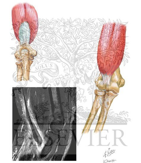 Rupture of Biceps and Triceps Tendon