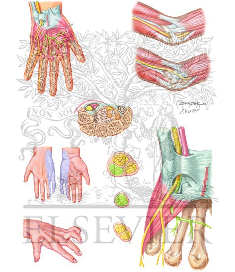 Cubital Tunner Syndrome