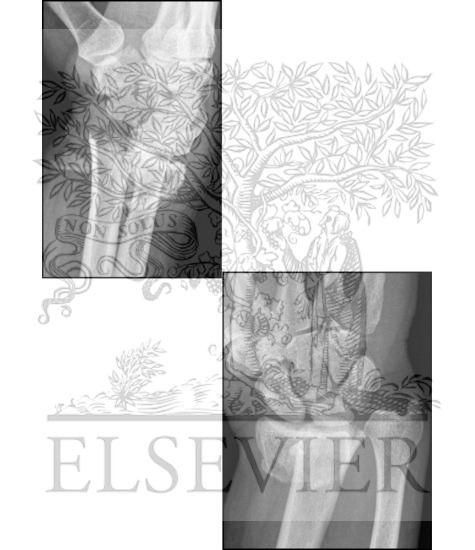 Radiology of Distal Radius Fractures