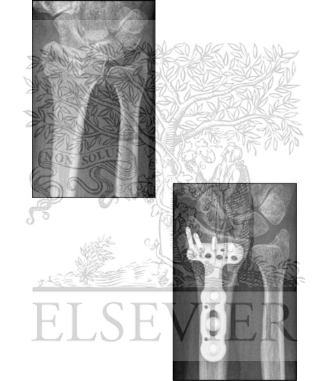 Watermarked preview of unlabeled image: Radiology of Open Reduction and Internal Fixation (ORIF)