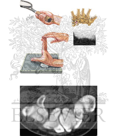 Fracture of Hamulus of Hamate