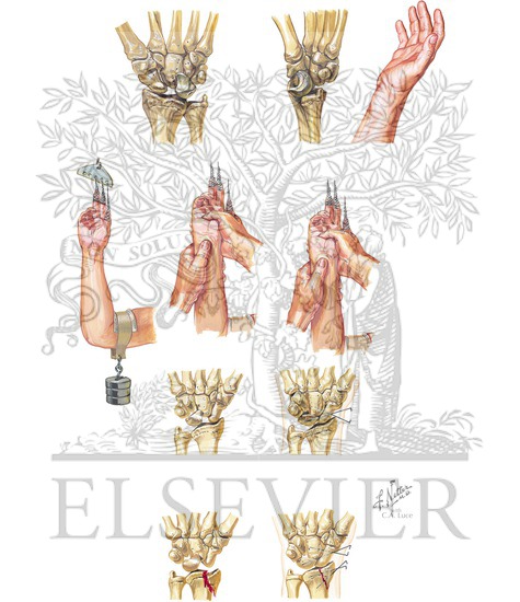 Watermarked preview of unlabeled image: Dislocation of Carpus: Presentation and Treatment