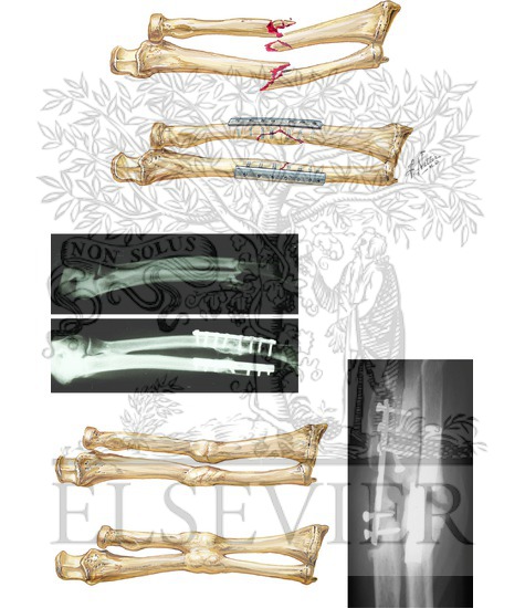 Fracture of Both Forearm Bones