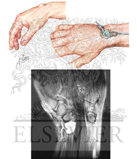 Watermarked preview of unlabeled image: Ganglion of Wrist