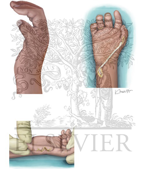 Watermarked preview of unlabeled image: Type II Hypoplastic Thumb