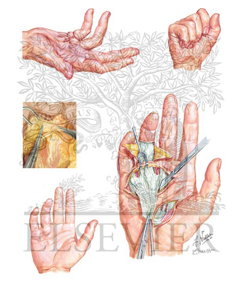 Presentation and Treatment of Dupuytren Contracture