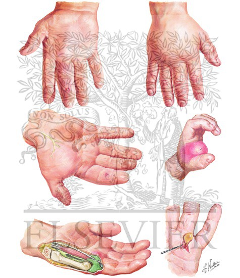 Infection of Deep Compartments of Hand