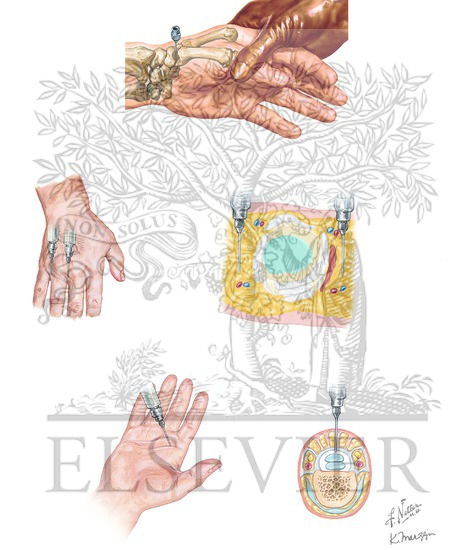 Thumb CMC Injection, Digital Block, and Flexor Sheath Injection
