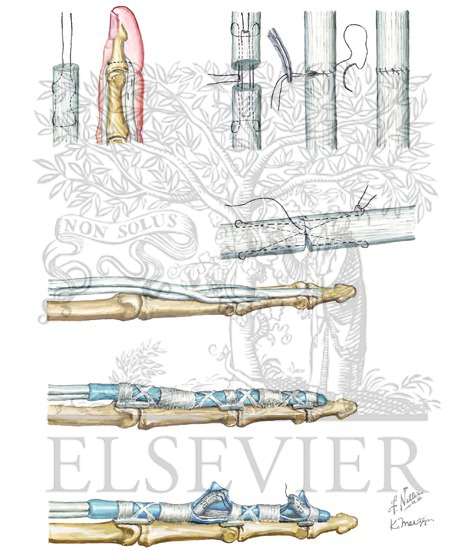 Watermarked preview of unlabeled image: Repair of Tendon