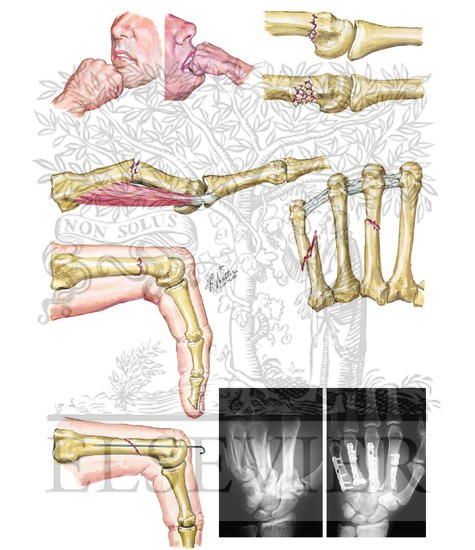 Fractures of Metacarpal Neck and Shaft