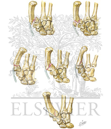 Watermarked preview of unlabeled image: Fracture of Thumb Metacarpal Base