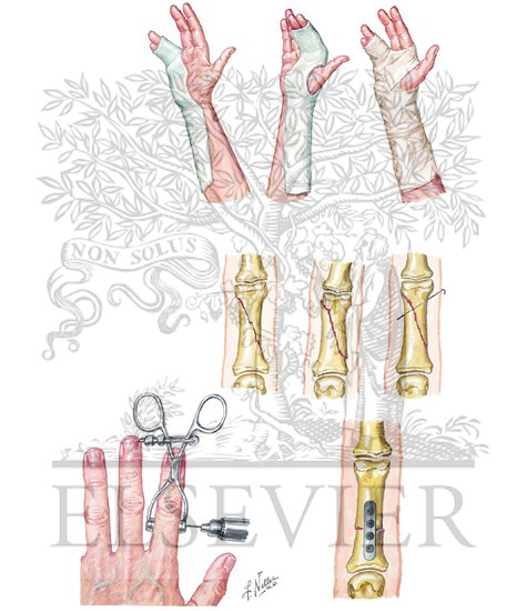 Management of Fracture of Proximal and Middle Phalanges