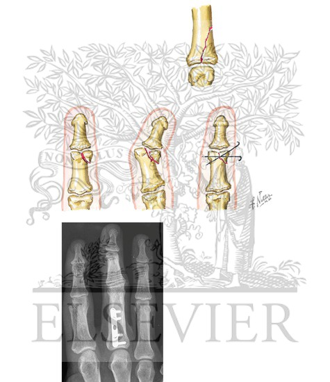 Watermarked preview of unlabeled image: Special Problems in Fracture of Middle and Proximal Phalanges