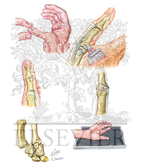 Watermarked preview of unlabeled image: Thumb Ligament Injury and Dislocation