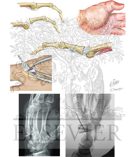 Carpometacarpal and Metacarpophalangeal Joint Injury
