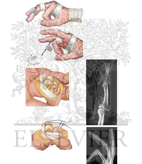 Treatment of Dorsal Interphalangeal Joint Dislocation
