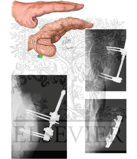 Watermarked preview of unlabeled image: Thumb Lengthening Post Amputation