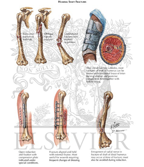 Watermarked preview of labeled image: Humeral Shaft Fractures