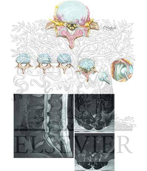 Lumbar Disc Herniation