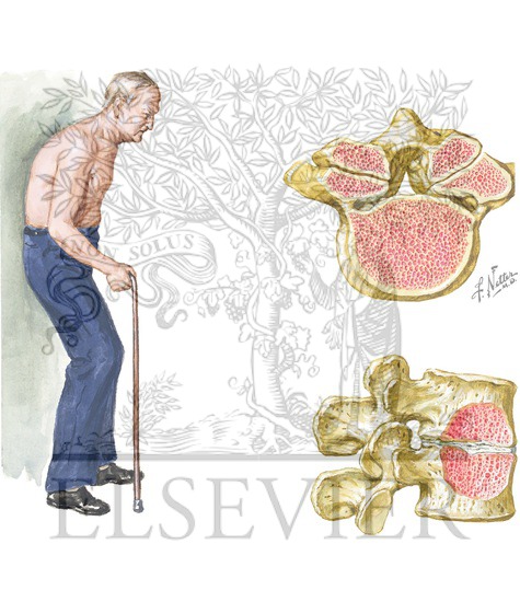 Watermarked preview of unlabeled image: Lumbar Spinal Stenosis