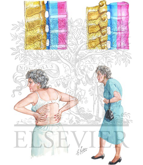 Watermarked preview of unlabeled image: Three-Column Concept of Spinal Stability and Compression Fractures
