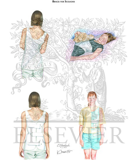 Braces for Scoliosis