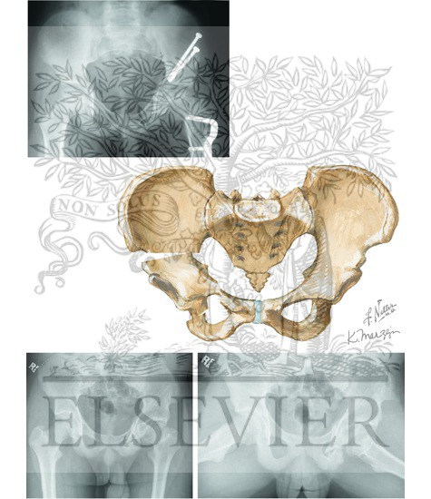 Watermarked preview of unlabeled image: Innominate Osteotomy (Continued)