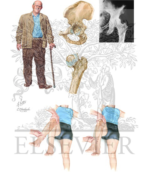 Watermarked preview of unlabeled image: Hip Joint Involvement in Osteoarthritis