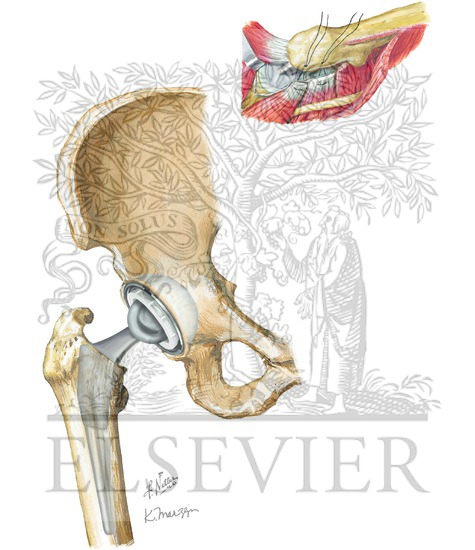 Watermarked preview of unlabeled image: Total Hip Replacement: Steps 19 and 20
