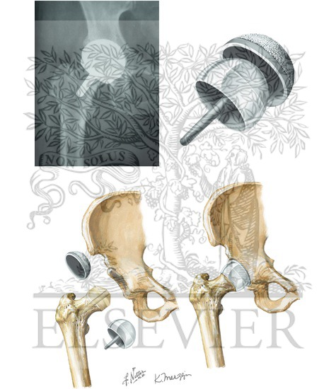 Watermarked preview of unlabeled image: Hip Resurfacing