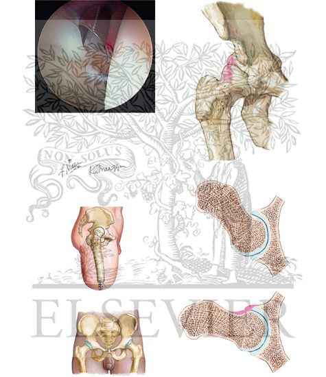 Femoroacetabular Impingement/Hip Labral Tears