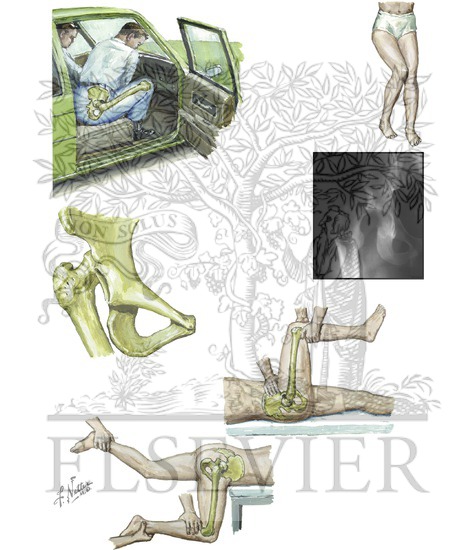 Watermarked preview of unlabeled image: Injury to Hip: Posterior Dislocation of Hip