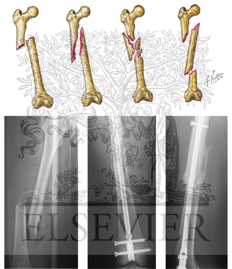 Watermarked preview of unlabeled image: Injury to Femur: Fracture of Shaft of Femur   