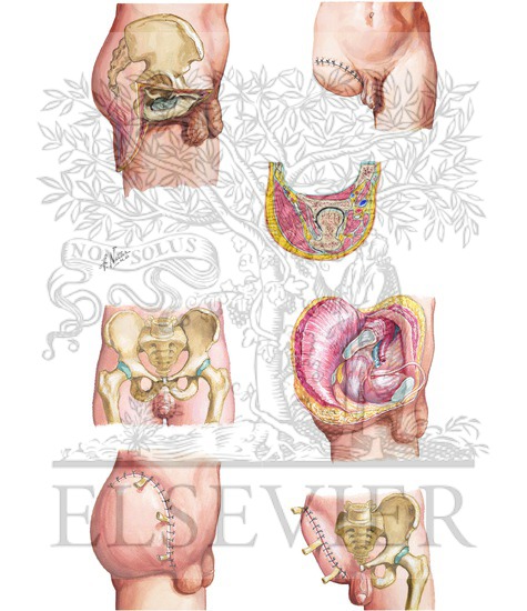 Amputation Of Lower Limb And Hip (Disarticulation And Hemipelvectomy)