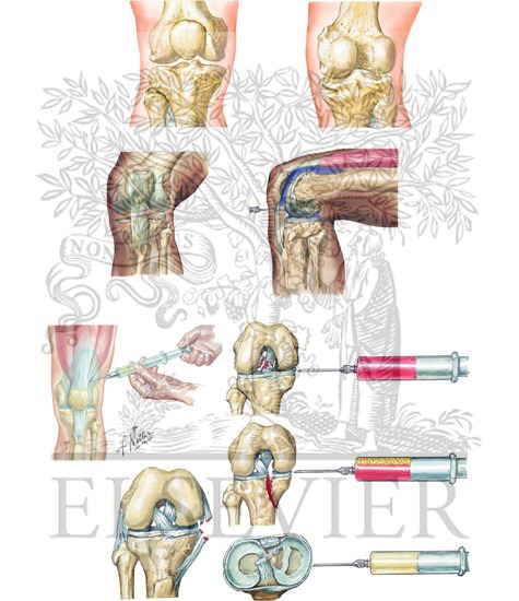 Arthrocentesis of Knee Joint